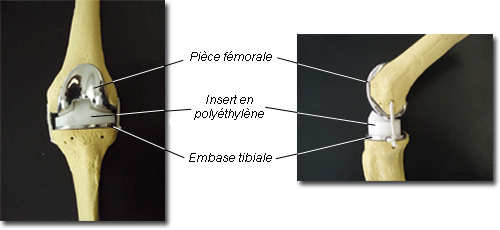 Prothèse totale de genou