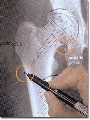 Resurfaçage de hanche Planification préopératoire