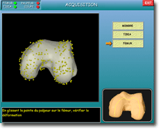 Ligamentoplastie