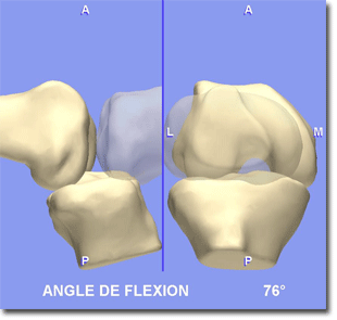 Ligamentoplastie