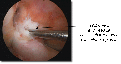 Ligamentoplastie