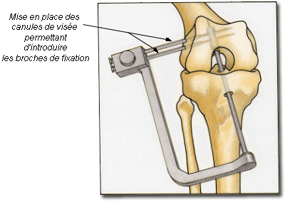 Ligamentoplastie