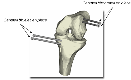 Ligamentoplastie